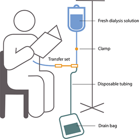 CAPD Line Diagram