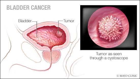 bladdercancer